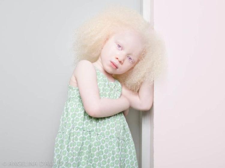 Albino